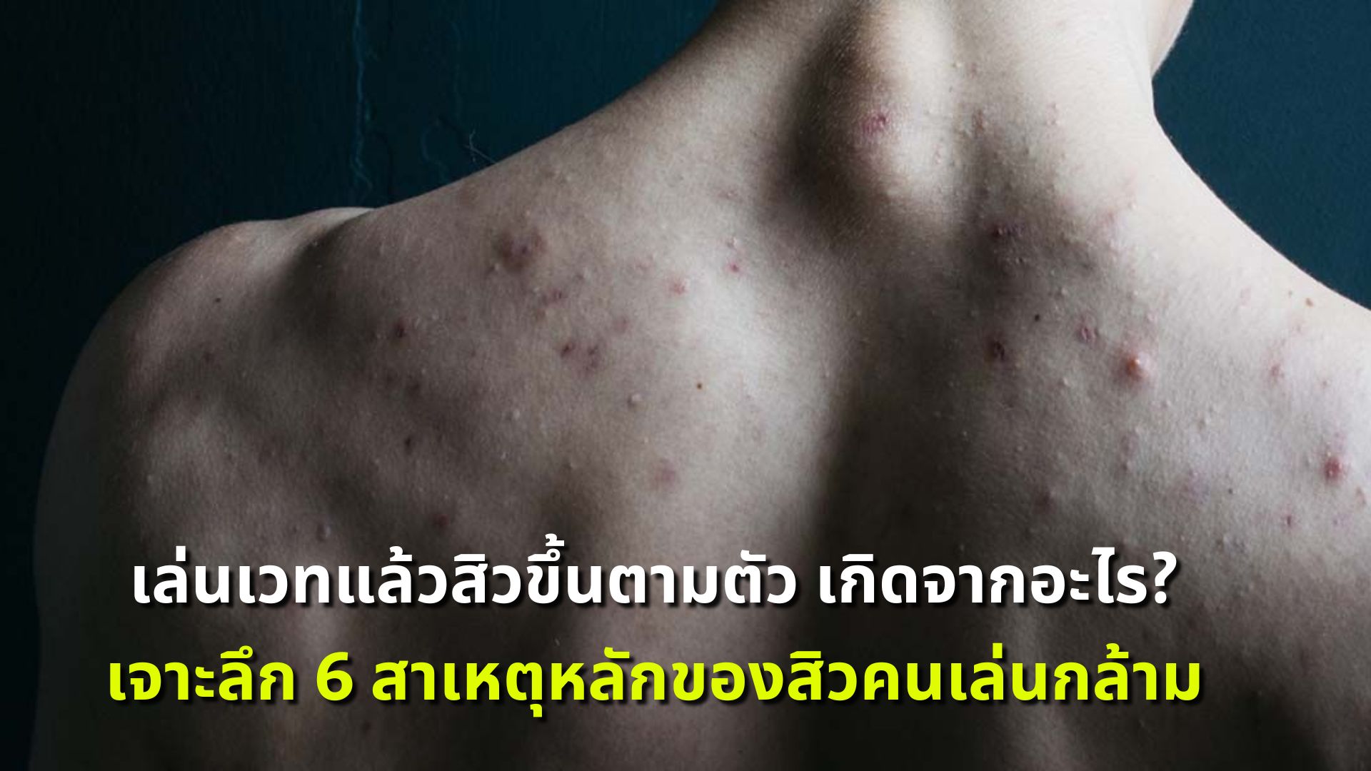 เล่นเวทแล้วสิวขึ้นตามตัว เกิดจากอะไร? เจาะลึก 6 สาเหตุหลักของสิวคนเล่นกล้าม